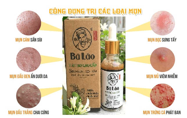 Sự Thực Kem Trị Mụn Bà Lão Có Lừa Đảo Người Dùng Không?