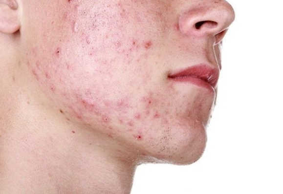 Serum Trị Mụn Bà Lão