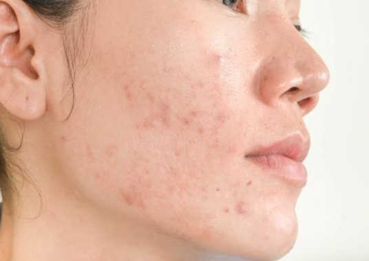 Sử Dụng Serum Trị Mụn Thâm Cho Da Có Tốt Không?